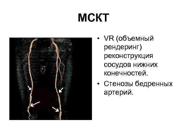 МСКТ • VR (объемный рендеринг) реконструкция сосудов нижних конечностей. • Стенозы бедренных артерий. 