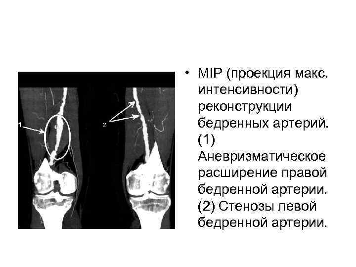  • МIP (проекция макс. интенсивности) реконструкции бедренных артерий. (1) Аневризматическое расширение правой бедренной