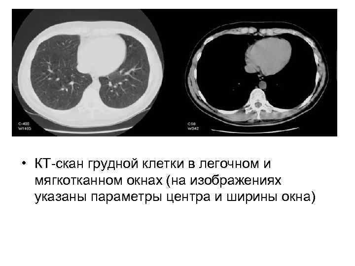 Мягкотканное образование в легком на кт. Мягкотканное окно на кт. Легочное окно на кт. Скан компьютерной томографии. Кт грудной клетки воздушное окно.