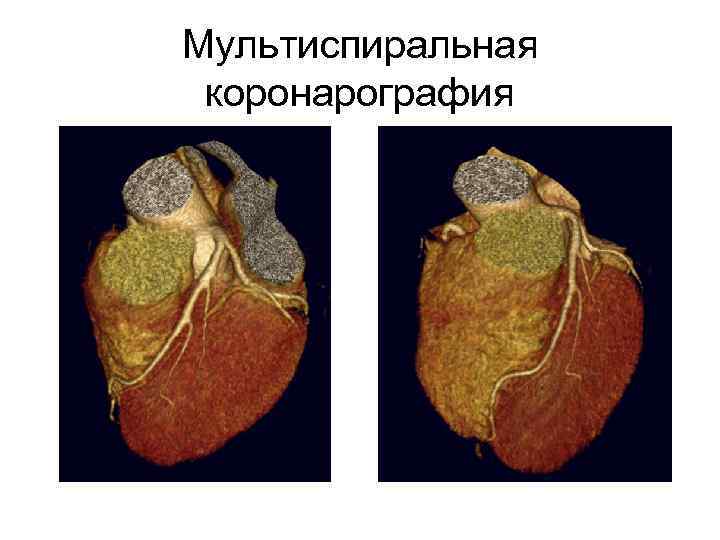 Мультиспиральная коронарография 