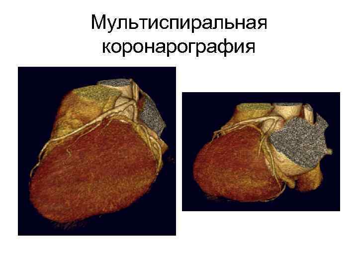 Мультиспиральная коронарография 