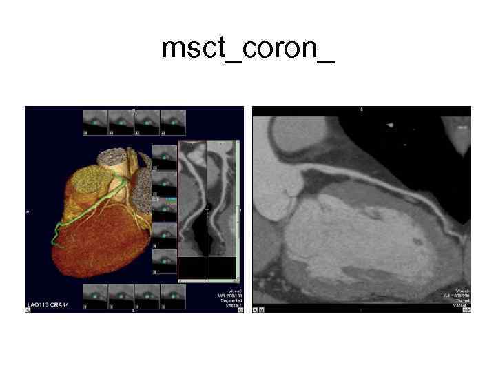 msct_coron_ 