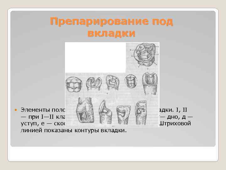Препарирование под вкладки Элементы полостей, сформированных под вкладки. I, II — при I—II классе;