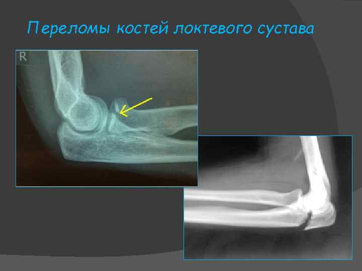 Переломы костей локтевого сустава 