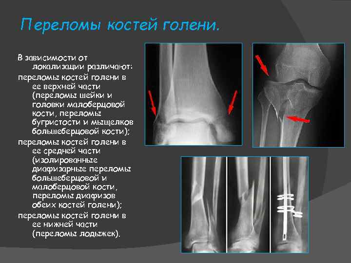 Переломы костей голени. В зависимости от локализации различают: переломы костей голени в ее верхней