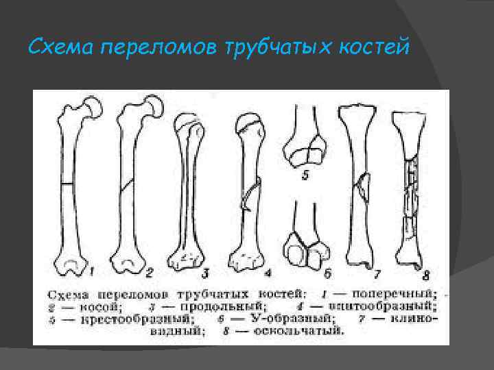 Схема переломов трубчатых костей 