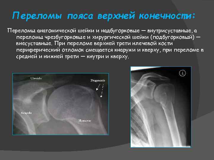 Переломы пояса верхней конечности: Переломы анатомической шейки и надбугорковые — внутрисуставные, а переломы чрезбугорковые