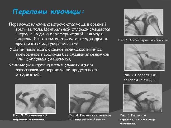 Переломы ключицы: Переломы ключицы встречаются чаще в средней трети ее тела. Центральный отломок смещается