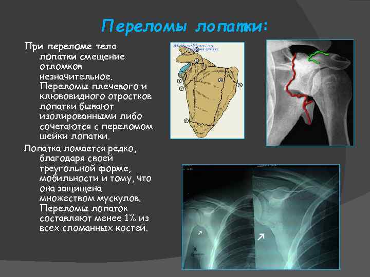 Переломы лопатки: При переломе тела лопатки смещение отломков незначительное. Переломы плечевого и клювовидного отростков