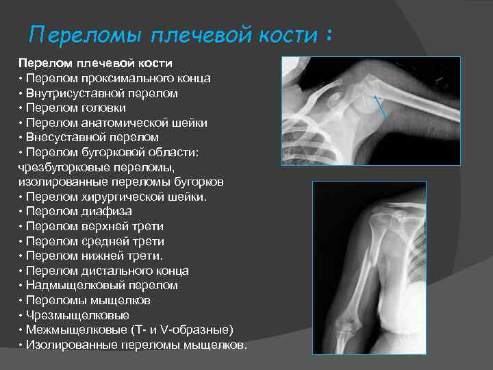 Переломы плечевой кости : Перелом плечевой кости • Перелом проксимального конца • Внутрисуставной перелом