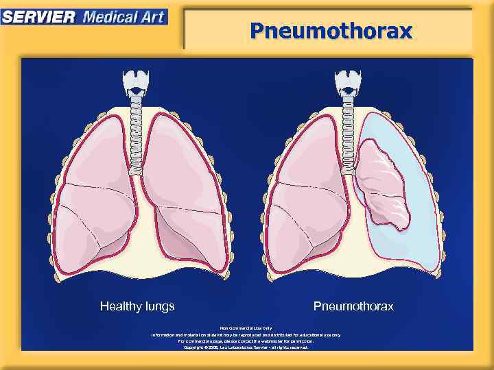 Pneumothorax Healthy lungs Pneumothorax Non Commercial Use Only Information and material on slide kit