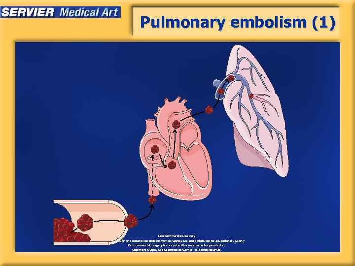 Pulmonary embolism (1) Non Commercial Use Only Information and material on slide kit may