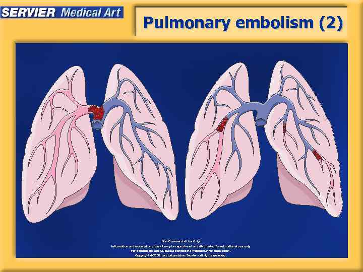 Pulmonary embolism (2) Non Commercial Use Only Information and material on slide kit may