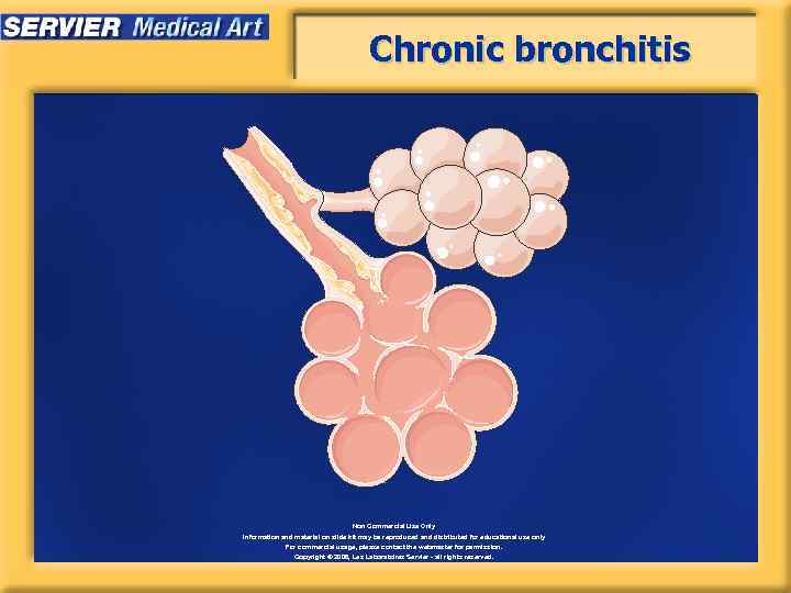 Chronic bronchitis Non Commercial Use Only Information and material on slide kit may be
