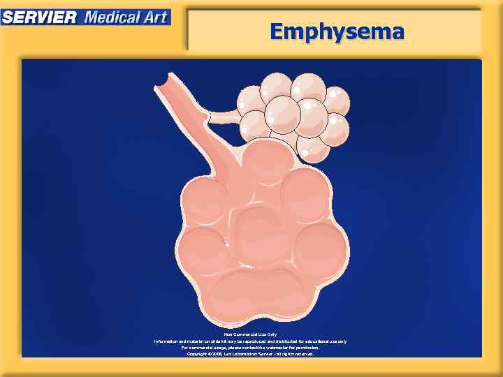 Emphysema Non Commercial Use Only Information and material on slide kit may be reproduced