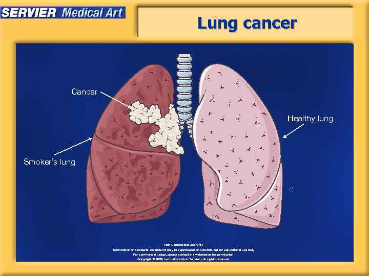 Lung cancer Cancer Healthy lung Smoker’s lung Non Commercial Use Only Information and material