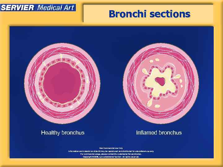Bronchi sections Healthy bronchus Inflamed bronchus Non Commercial Use Only Information and material on