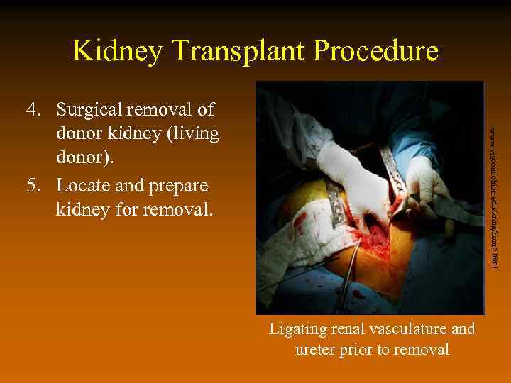 Kidney Transplant Procedure www. viscom. ohiou. edu/kring/home. html 4. Surgical removal of donor kidney