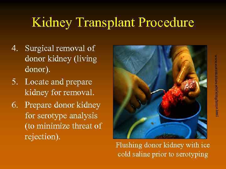 Kidney Transplant Procedure www. viscom. ohiou. edu/kring/home. html 4. Surgical removal of donor kidney