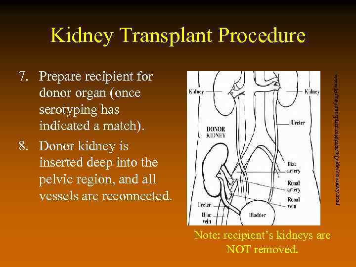 Kidney Transplant Procedure www. kidneytransplant. org/patientguide/insurgrey. html 7. Prepare recipient for donor organ (once