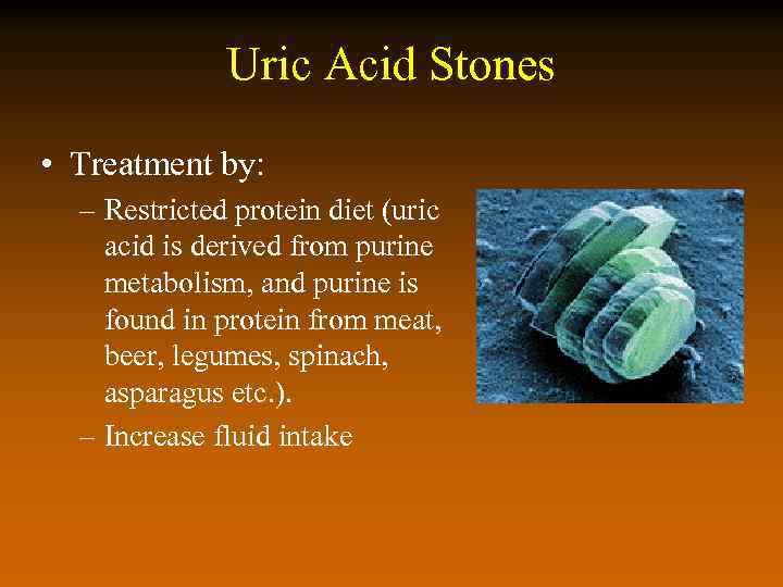 Uric Acid Stones • Treatment by: – Restricted protein diet (uric acid is derived