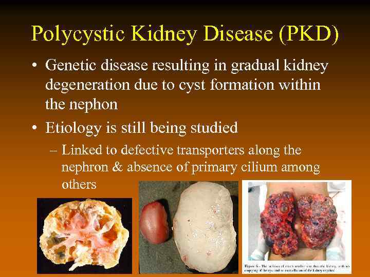 Polycystic Kidney Disease (PKD) • Genetic disease resulting in gradual kidney degeneration due to