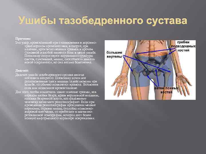 Ушибы тазобедренного сустава Причины Это удар, происходящий при столкновении в дорожнотранспортном происшествии, в спорте,