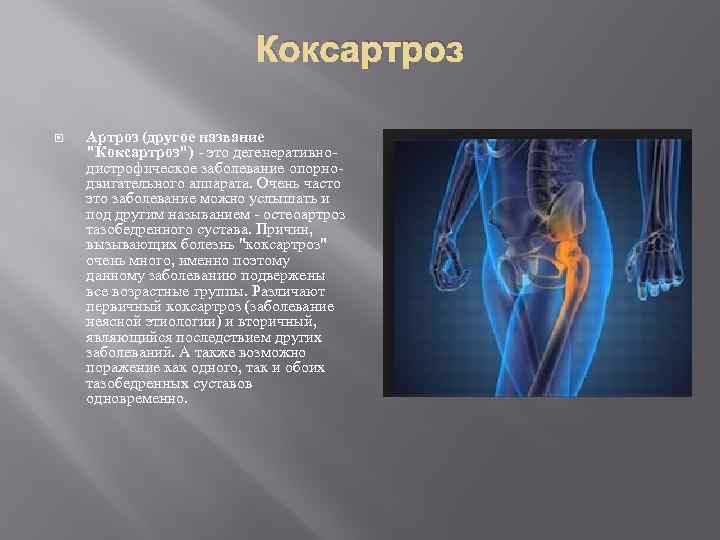 Коксартроз Артроз (другое название "Коксартроз") - это дегенеративнодистрофическое заболевание опорнодвигательного аппарата. Очень часто это