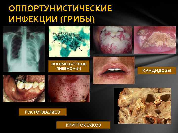 ОППОРТУНИСТИЧЕСКИЕ ИНФЕКЦИИ (ГРИБЫ) ПНЕВМОЦИСТНЫЕ ПНЕВМОНИИ ГИСТОПЛАЗМОЗ КРИПТОКОККОЗ КАНДИДОЗЫ 