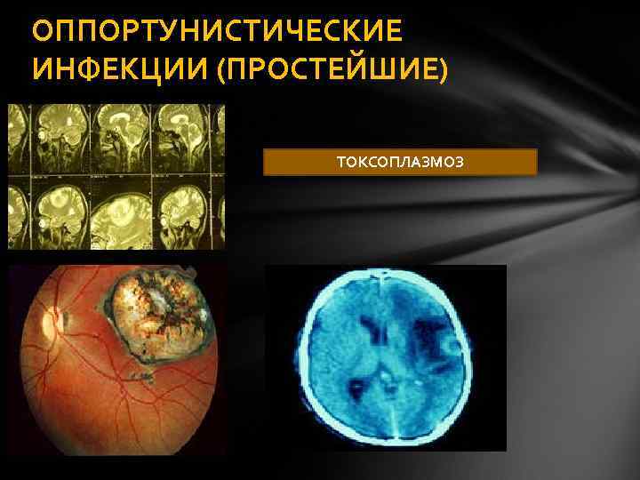 ОППОРТУНИСТИЧЕСКИЕ ИНФЕКЦИИ (ПРОСТЕЙШИЕ) ТОКСОПЛАЗМОЗ 