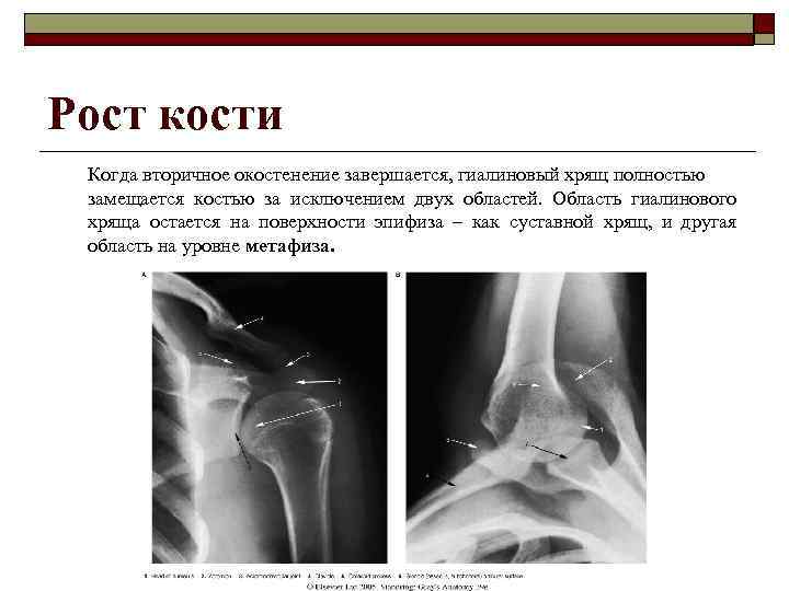 Рост кости Когда вторичное окостенение завершается, гиалиновый хрящ полностью замещается костью за исключением двух