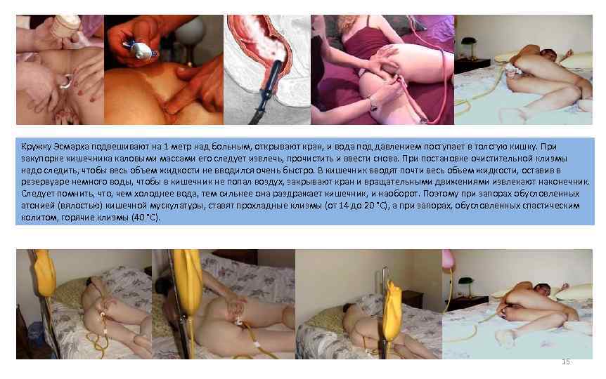 Кружку Эсмарха подвешивают на 1 метр над больным, открывают кран, и вода под давлением