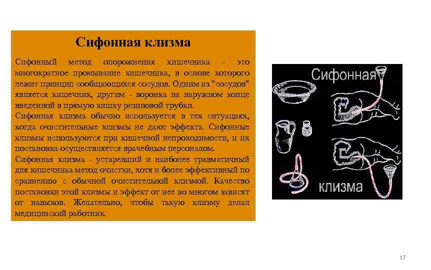 Сифонная клизма Сифонный метод опорожнения кишечника - это многократное промывание кишечника, в основе которого