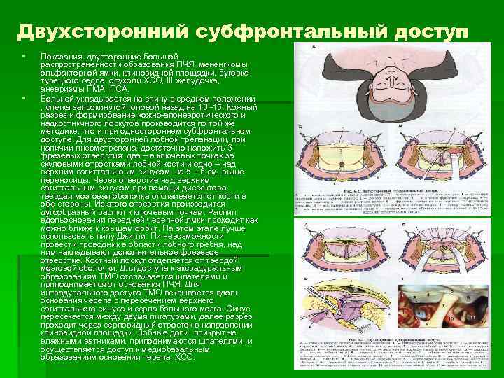 Двухсторонний субфронтальный доступ § § Показания: двусторонние большой распространенности образования ПЧЯ, мененгиомы ольфакторной ямки,