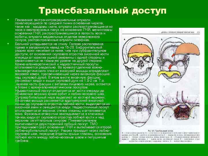 Трансбазальный доступ § § Показания: экстра-интракраниальные опухоли, локализующиеся по средней линии основания черепа, такие