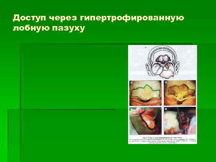 Доступ через гипертрофированную лобную пазуху 