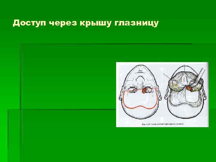 Доступ через крышу глазницу 