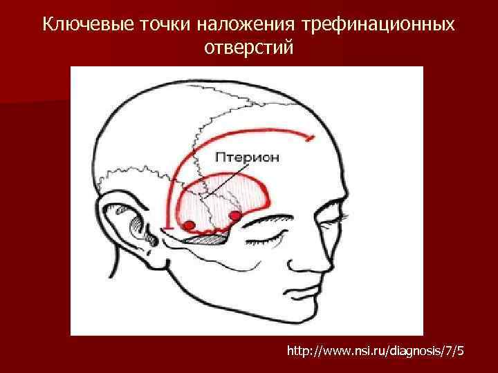 Ключевые точки наложения трефинационных отверстий http: //www. nsi. ru/diagnosis/7/5 