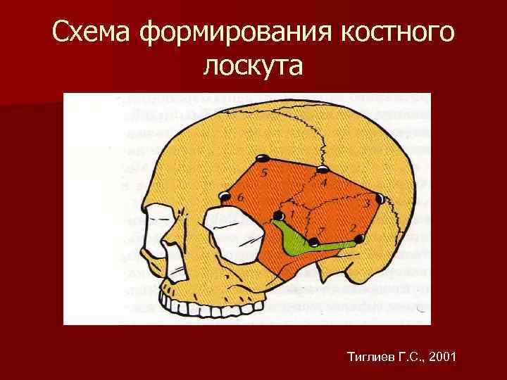 Схема формирования костного лоскута Тиглиев Г. С. , 2001 