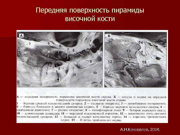 Пирамиды височной. Ячейки пирамид височных костей. Верхушка пирамиды височных костей. Передней поверхности пирамид височных костей. Передняя поверхность пирамиды височной кости кости.