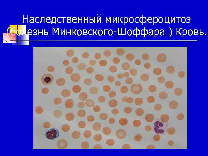 Наследственный микросфероцитоз (болезнь Минковского-Шоффара ) Кровь. 