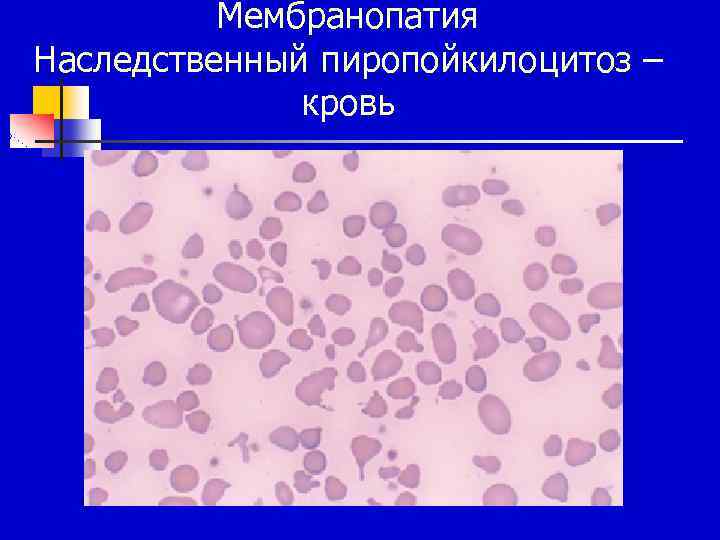 Мембранопатия Наследственный пиропойкилоцитоз – кровь 