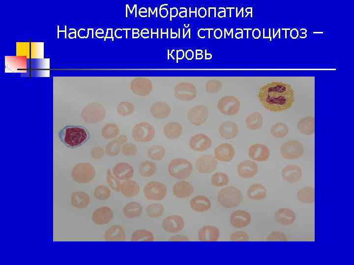 Мембранопатия Наследственный стоматоцитоз – кровь 