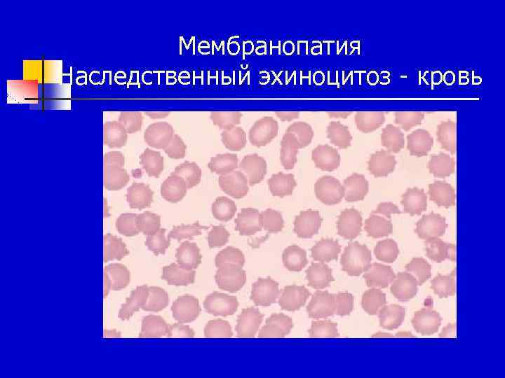 Мембранопатия Наследственный эхиноцитоз - кровь 