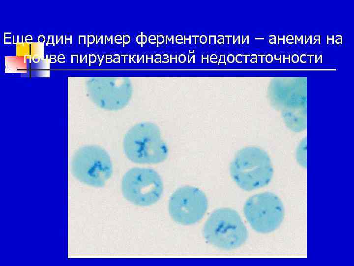 Еще один пример ферментопатии – анемия на почве пируваткиназной недостаточности 