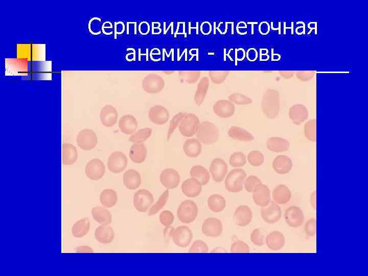 Серповидноклеточная анемия картина крови