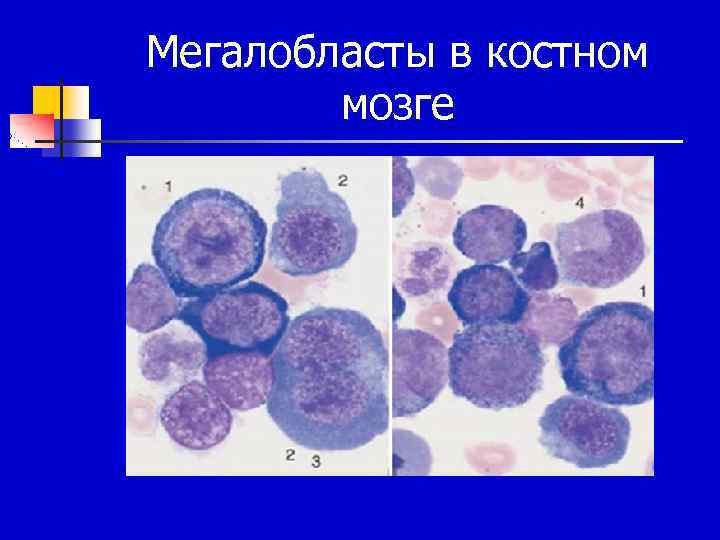 Мегалобласты в костном мозге 