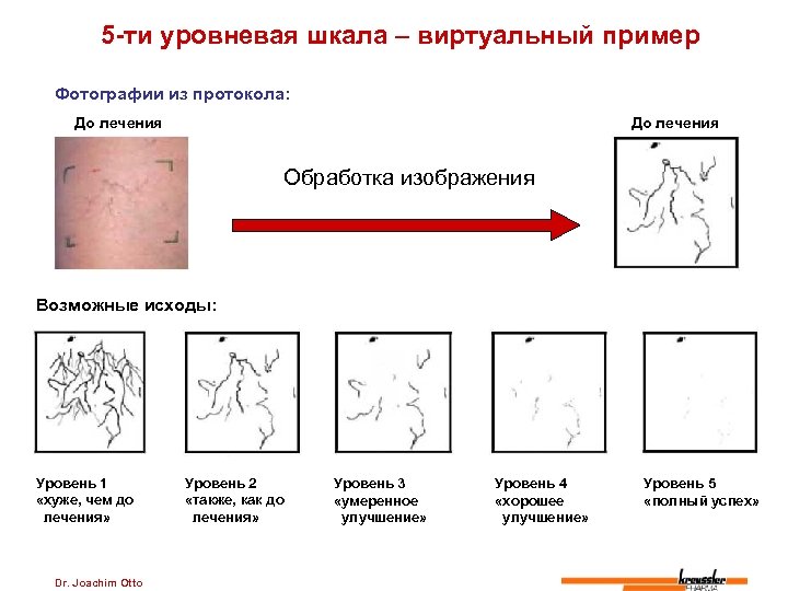5 -ти уровневая шкала – виртуальный пример Фотографии из протокола: До лечения Обработка изображения
