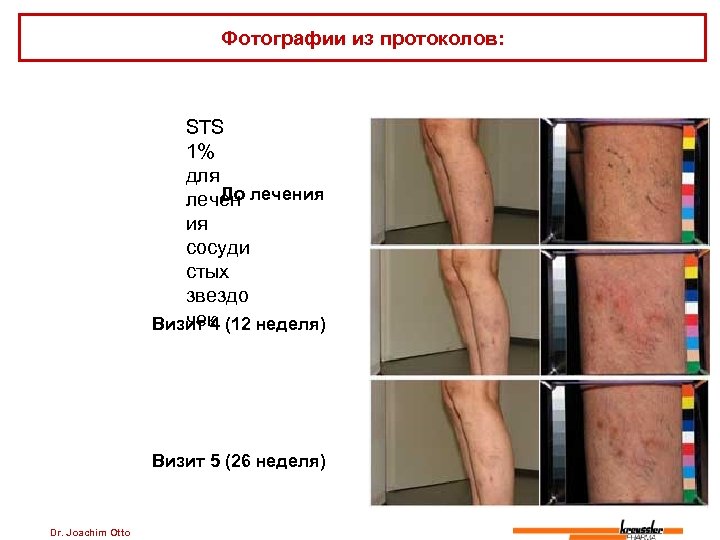 Фотографии из протоколов: STS 1% для До лечения ия сосуди стых звездо чек Визит