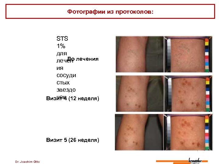 Фотографии из протоколов: STS 1% для До лечения ия сосуди стых звездо чек Визит